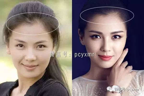移发际线_双移线工况是什么样的_发际线后移是什么意思