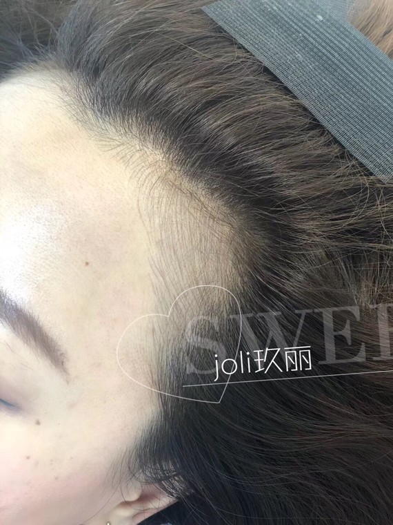 发际线后移是什么意思_双移线工况是什么样的_移发际线