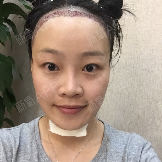 发际线后移是什么意思_移发际线_双移线工况是什么样的