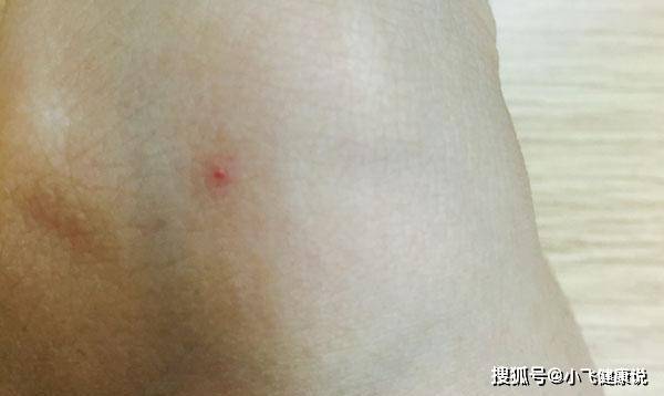 右手上出现红点是什么_右手手上有红点_右手有红点